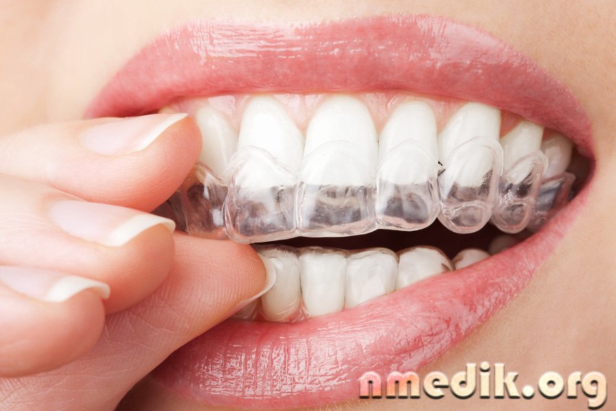 Отбеливание зубов с помощью геля